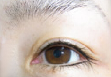 アイライン上施術例直後