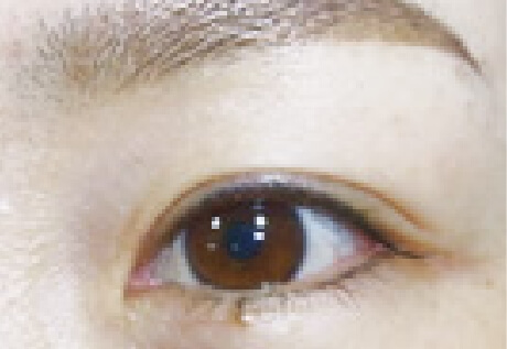 アイライン上施術例After