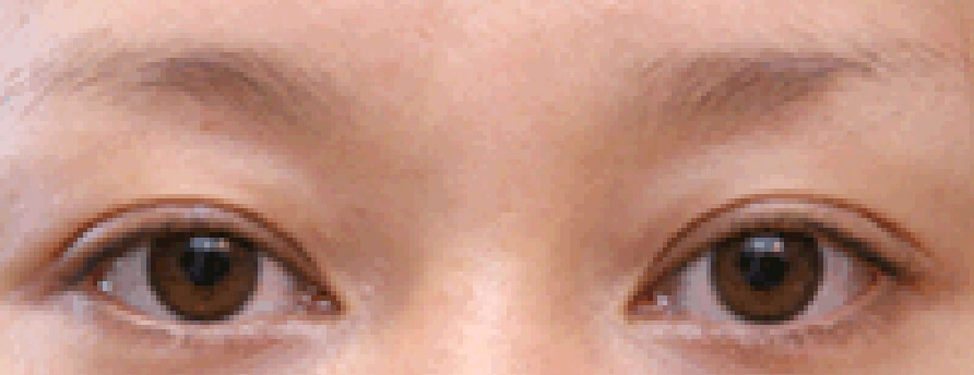 眉&plus;アイライン上&plus;アイライン下施術例Before