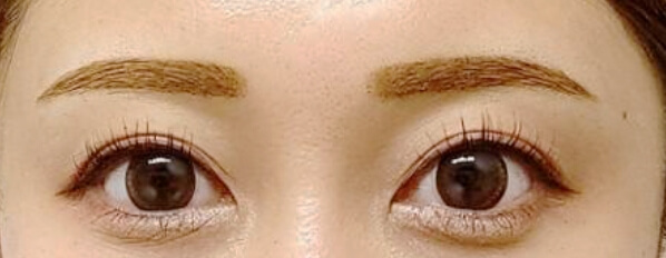 眉施術例After